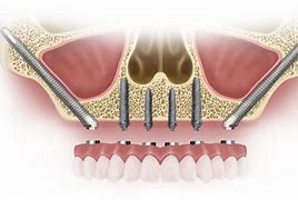Image result for Zygomatic Dental Implants