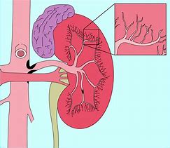 Image result for Bilateral Renal Artery Stenosis