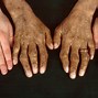 Image result for hemofromatosis