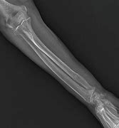 Image result for Broken Arm Bone Sticking Out