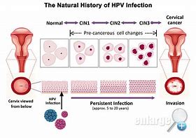 Image result for HPV Cervical Cancer