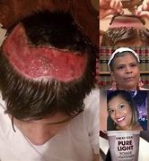 Image result for Hair Dye Chemical Burn