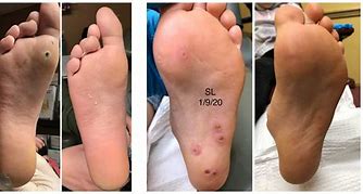 Image result for Swift Wart Treatment