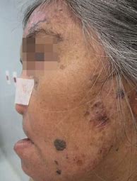 Image result for Actinic Keratosis