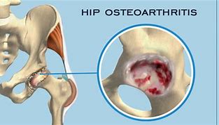 Image result for Wherre Can Bone Spur Grow Hip
