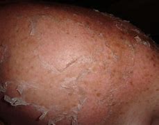 Image result for Skin Cancer From SunBurn