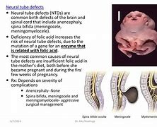 Image result for Cranial Neural Tube Defects