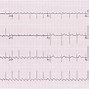 Image result for Accelerated Idioventricular Rhythm