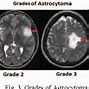 Image result for 4 Cm Tumor