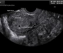 Image result for Transvaginal Ultrasound 4 Weeks