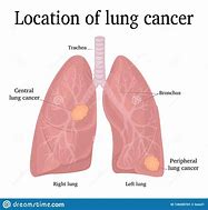 Image result for Lung Cancer Diagram