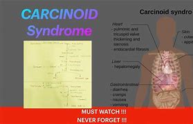 Image result for Carcinoid Crisis