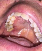 Image result for Kaposi Sarcoma Tongue