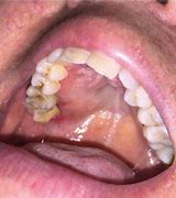 Image result for Kaposi Sarcoma Tongue
