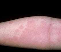 Image result for Rash and Blisters On Arm