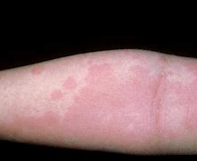 Image result for Allergic Reaction Skin Rash