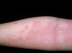 Image result for Skin Rash From Allergies
