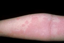 Image result for Skin Allergy Rashes