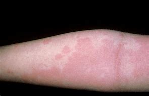 Image result for Most Common Skin Rashes