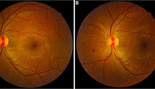 Image result for Diabetes Retina