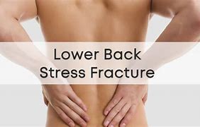 Image result for Stress Fracture in Back