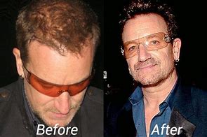 Image result for Bono Hair Transplant