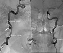 Image result for Aneurysm of Internal Carotid Artery
