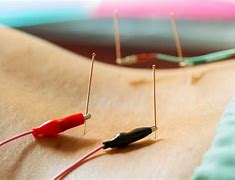 Image result for Electroacupuncture