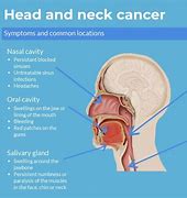 Image result for Cancer Tumors On Neck