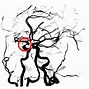 Image result for Carotid Doppler Ultrasound Stenosis
