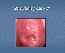 Image result for Strawberry Cervix