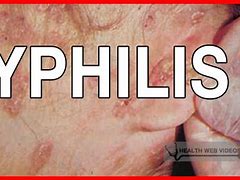 Image result for Permanent Syphilis Rash