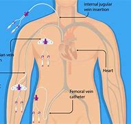 Image result for Femoral Central Venous Catheter