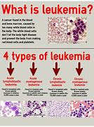 Image result for What Is Leukemia Cancer