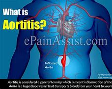 Image result for aortitis