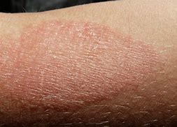 Image result for Eczema Brown Skin