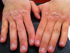 Image result for Viral Warts Treatment