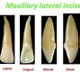 Image result for Upper Right Lateral Incisor