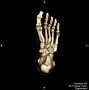 Image result for Jones Fracture Treatment