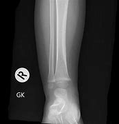 Image result for Toller Broken Foot