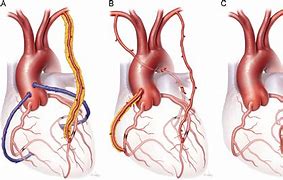 Image result for Arterial Bypass