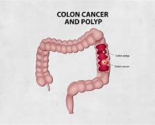 Image result for 20 mm Polyp in Colon