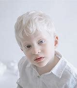 Image result for albinismi