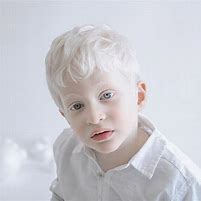 Image result for albinosmo
