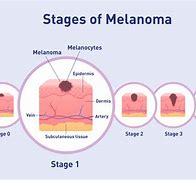 Image result for Melanoma Pictures Stage 1