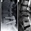 Image result for Lumbar Spinal Fusion L4-L5