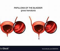 Image result for Papilloma Symptoms