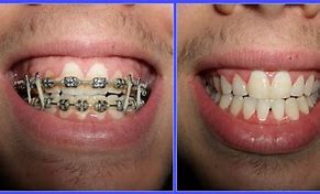 Image result for Braces Before and After