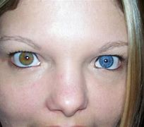 Image result for Barva OCI Sectral Heterochromia