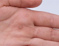 Image result for Flat Wart On Finger